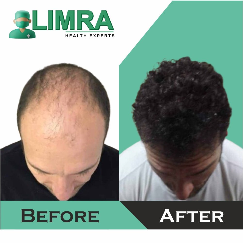 hair transplant in delhi